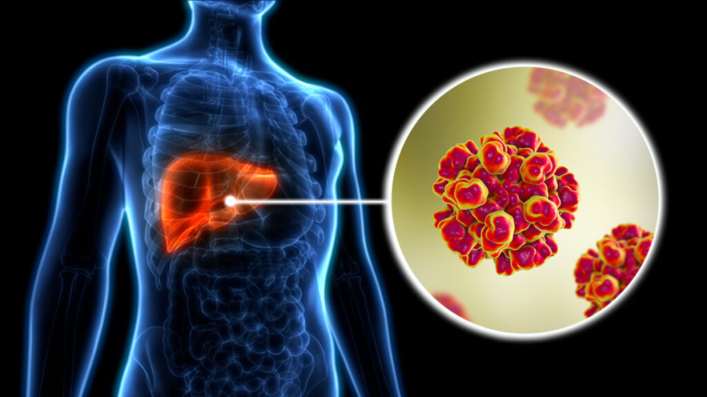 Hepatitis